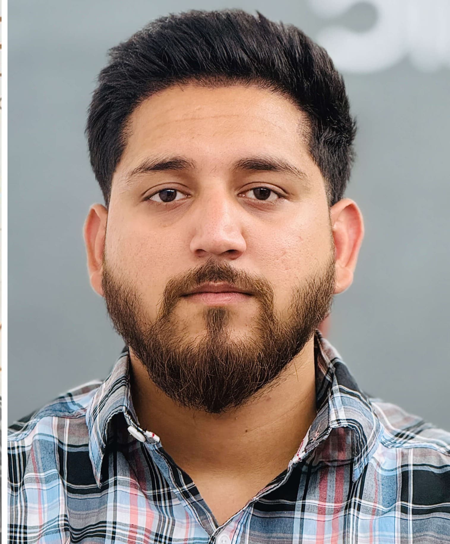 Hair transplant result 1