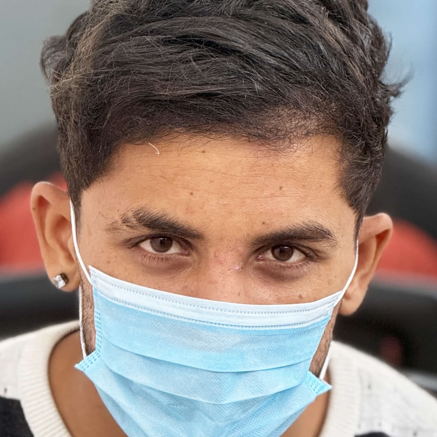 Hair transplant result 8