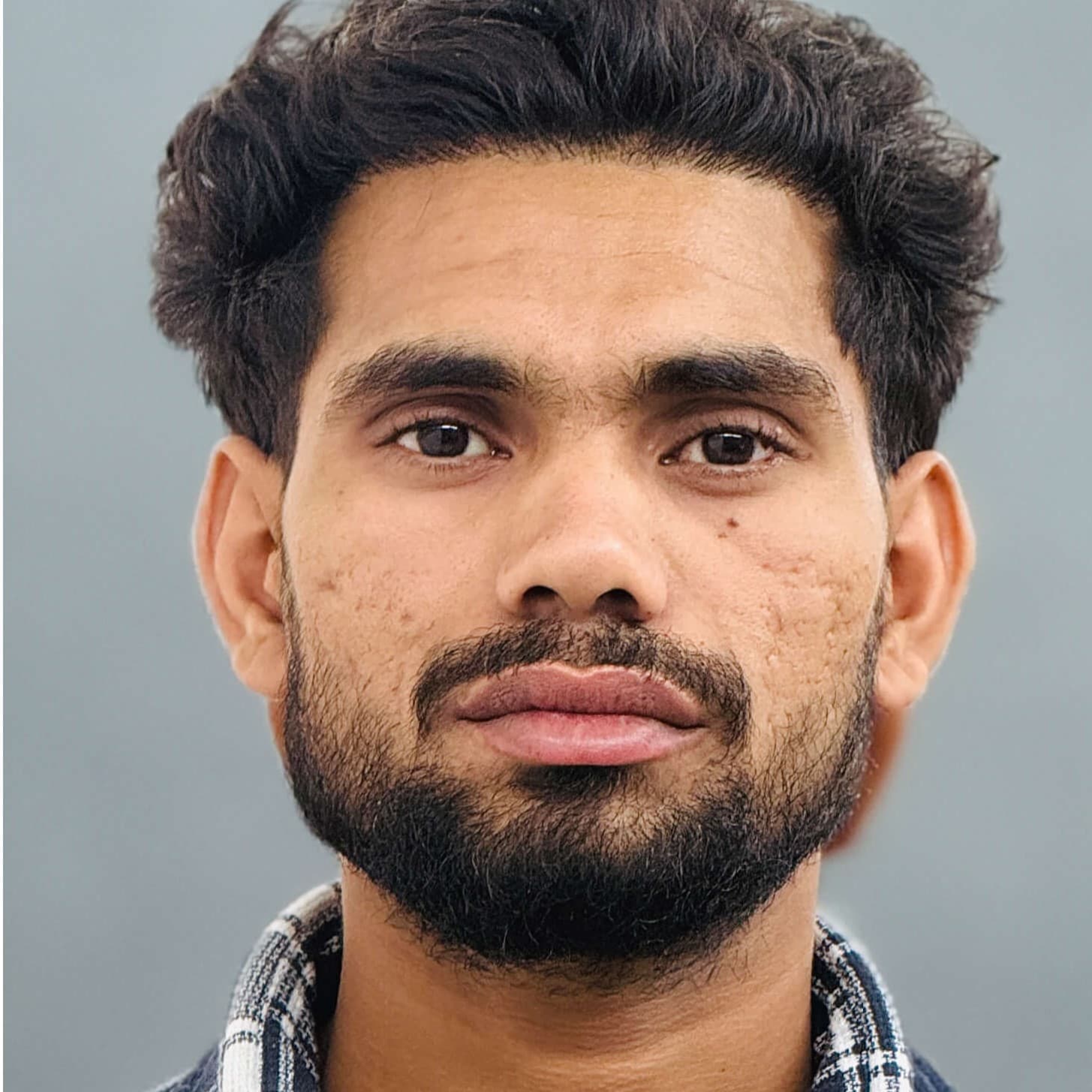 Hair transplant result 9