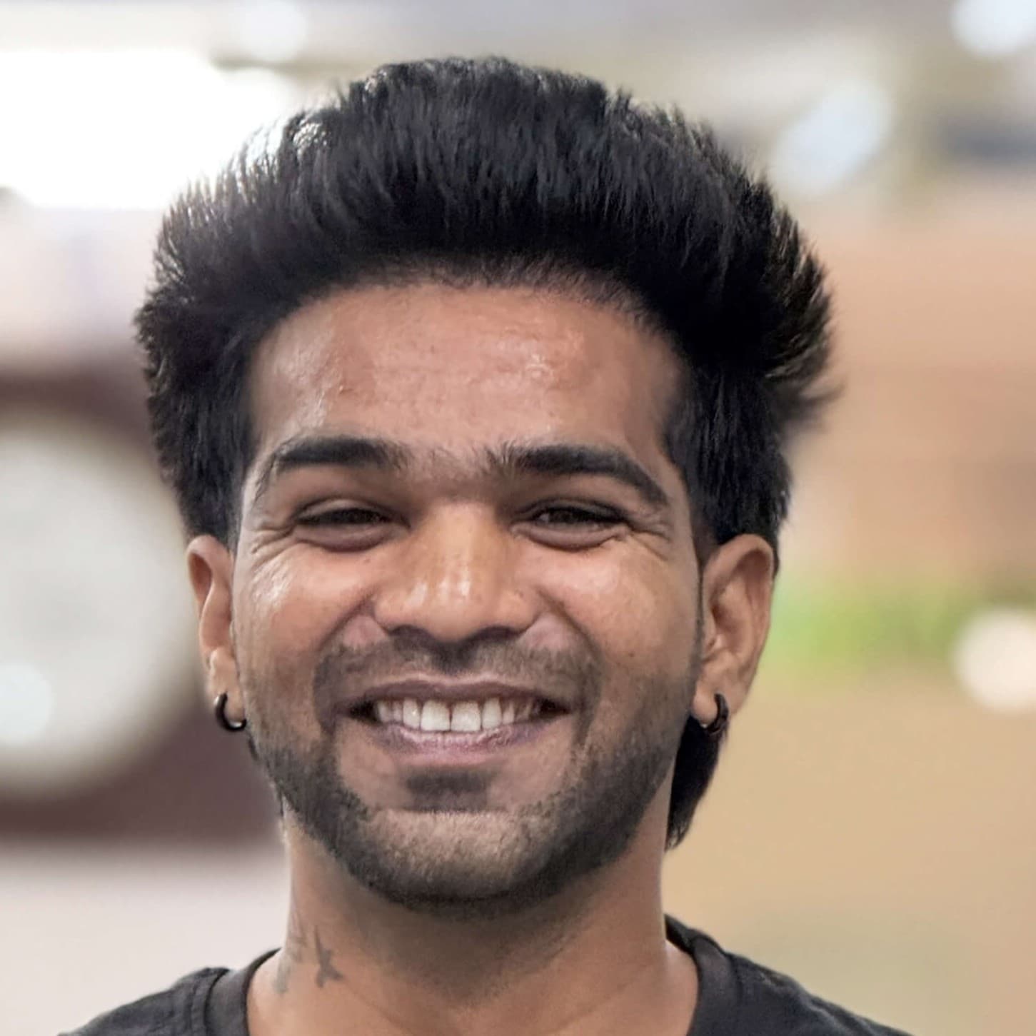 Hair transplant result 11