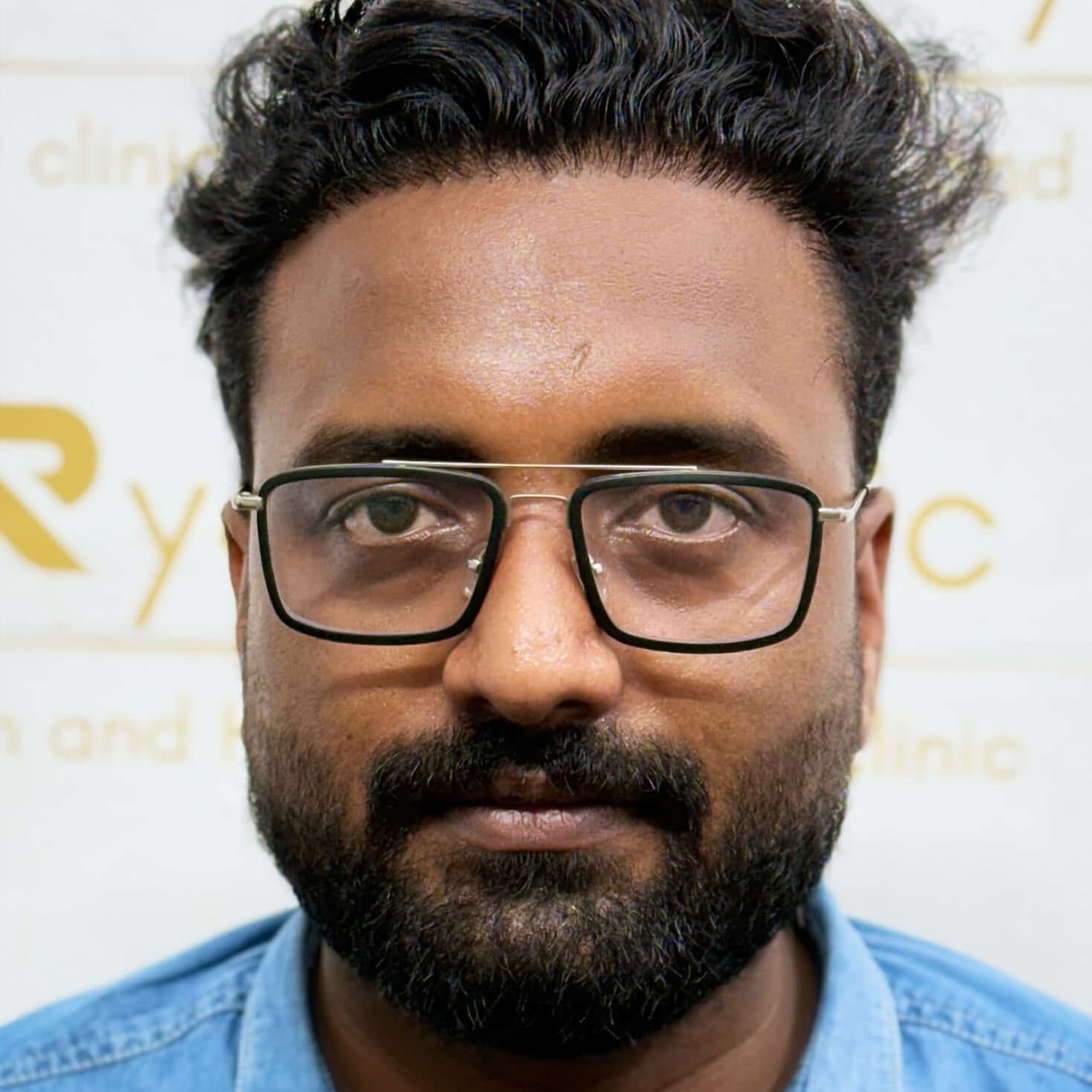 Hair transplant result 12